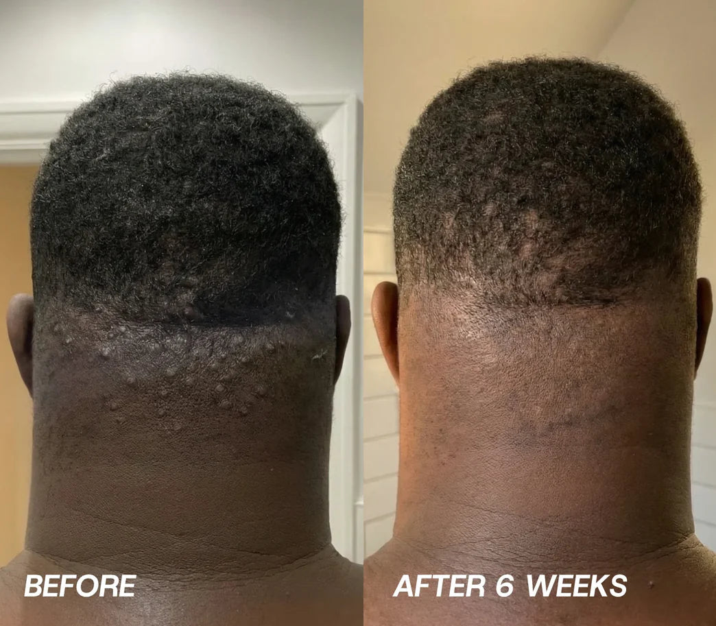 Post-Shave Ingrown Hair Serum