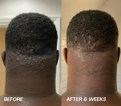 Post-Shave Ingrown Hair Serum